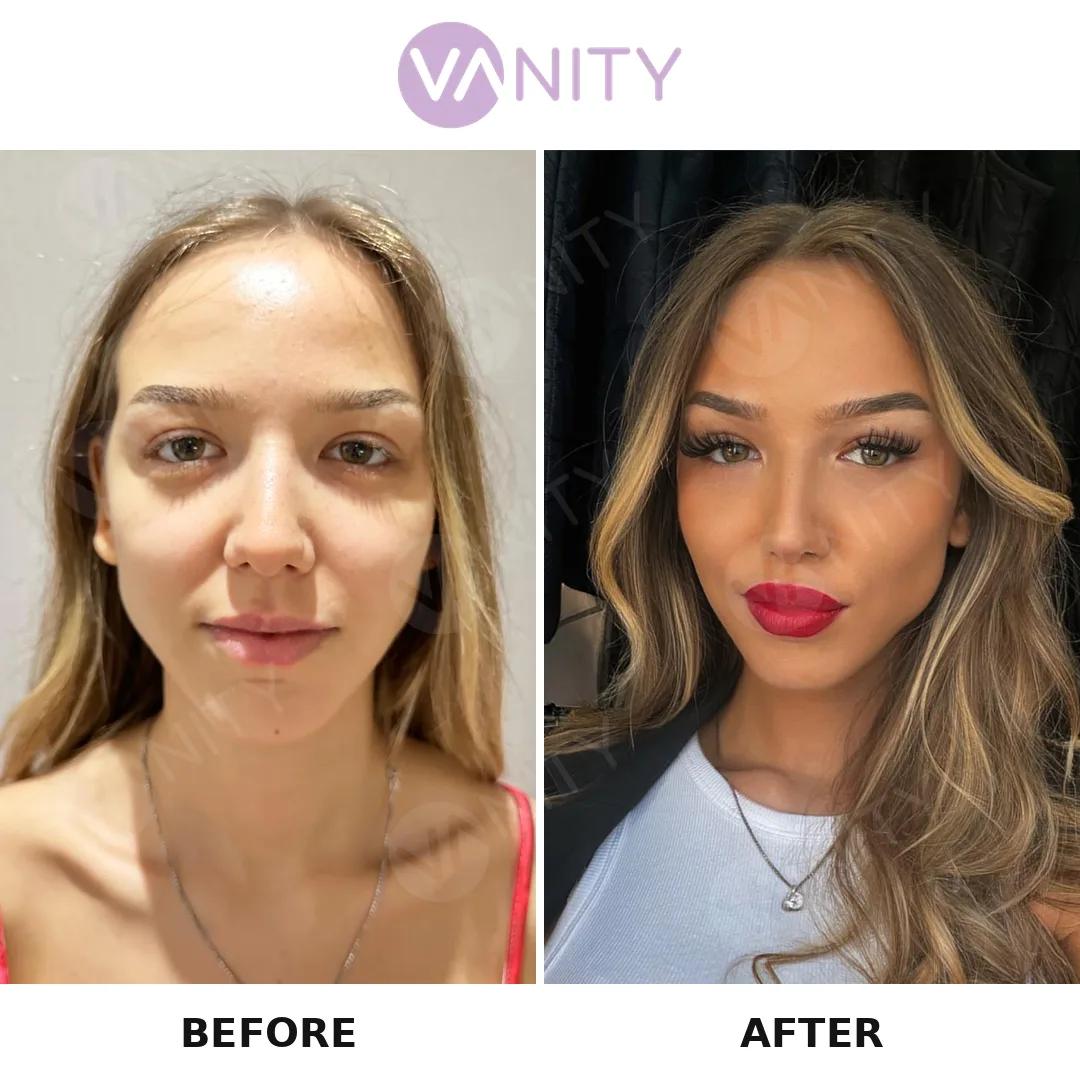 Rhinoplasty Istanbul