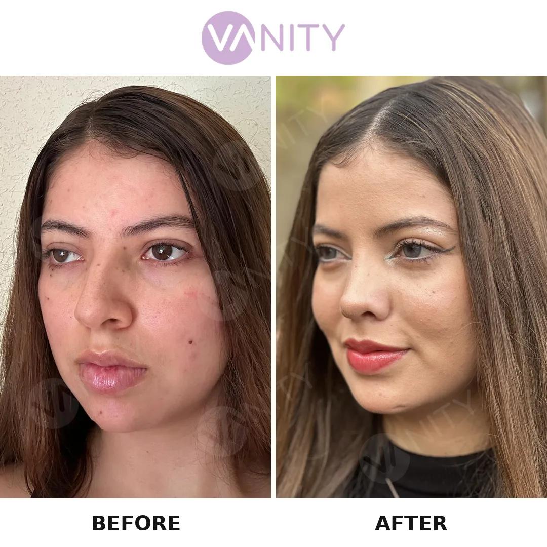 Rhinoplasty Istanbul