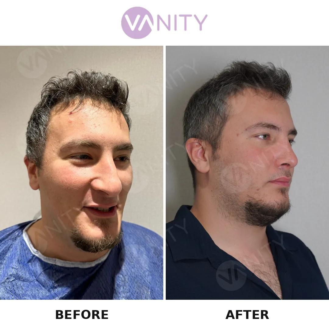 Rhinoplasty Istanbul
