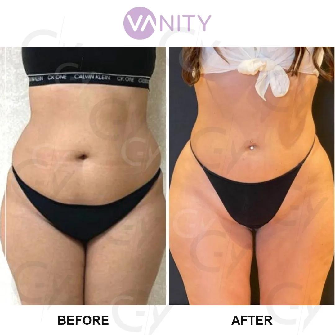 liposuccion Istanbul