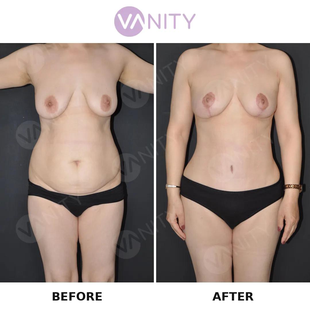 Breast Lift - Vanity Istanbul turkey