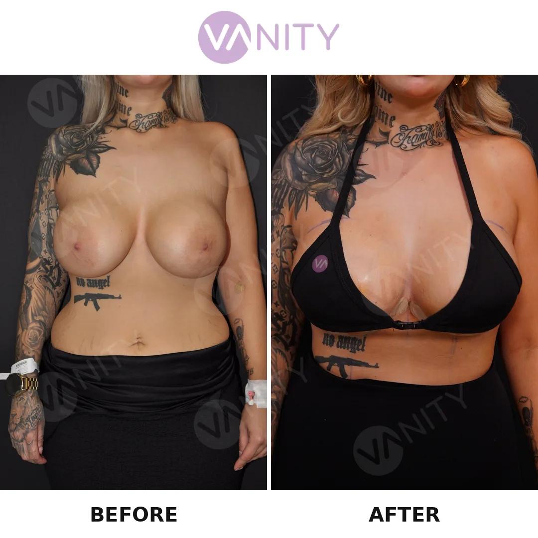 Breast Lift - Vanity Istanbul turkey