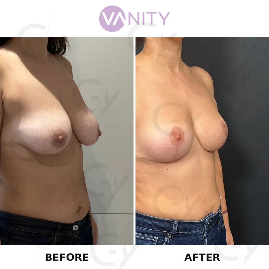Breast Lift - Vanity Istanbul turkey