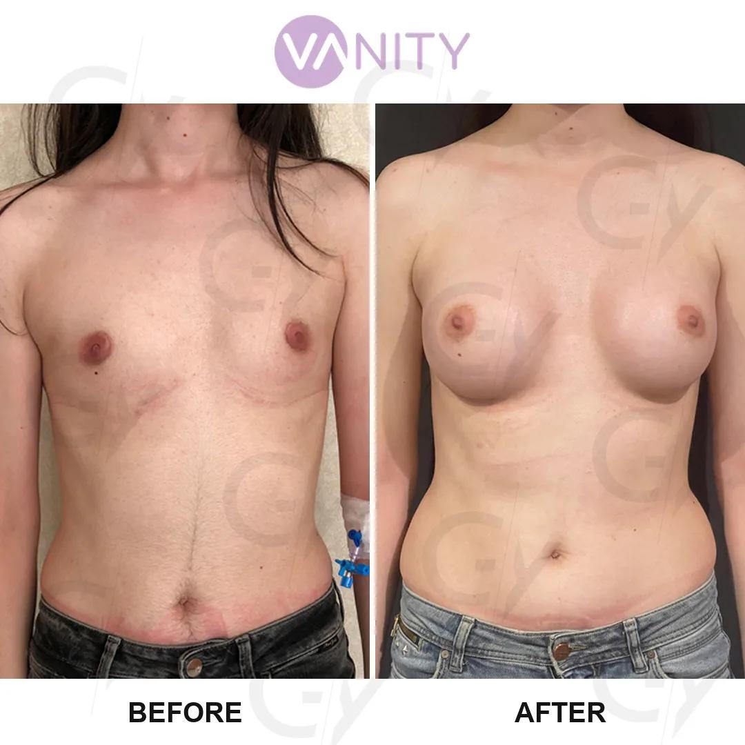 Breast augmentation Istanbul