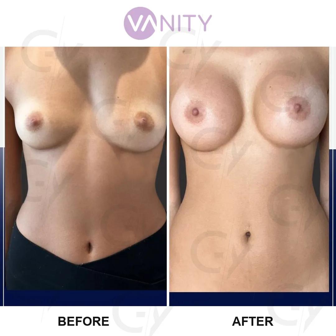 Breast augmentation Istanbul