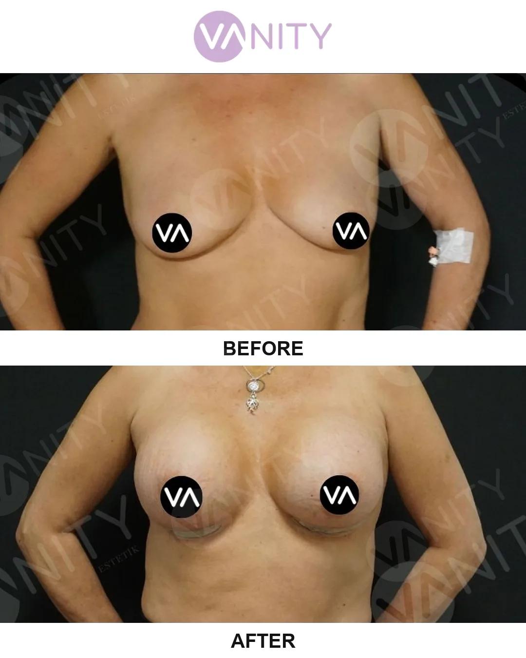 Breast augmentation Istanbul