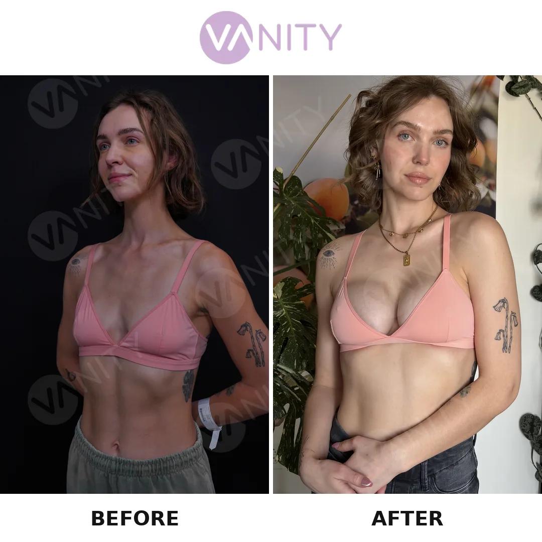 Breast augmentation Istanbul