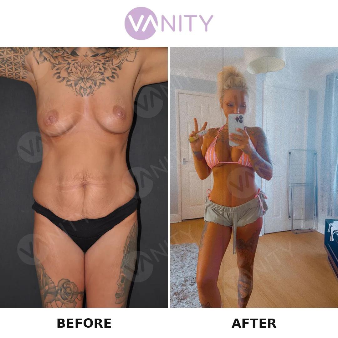 Breast augmentation Istanbul
