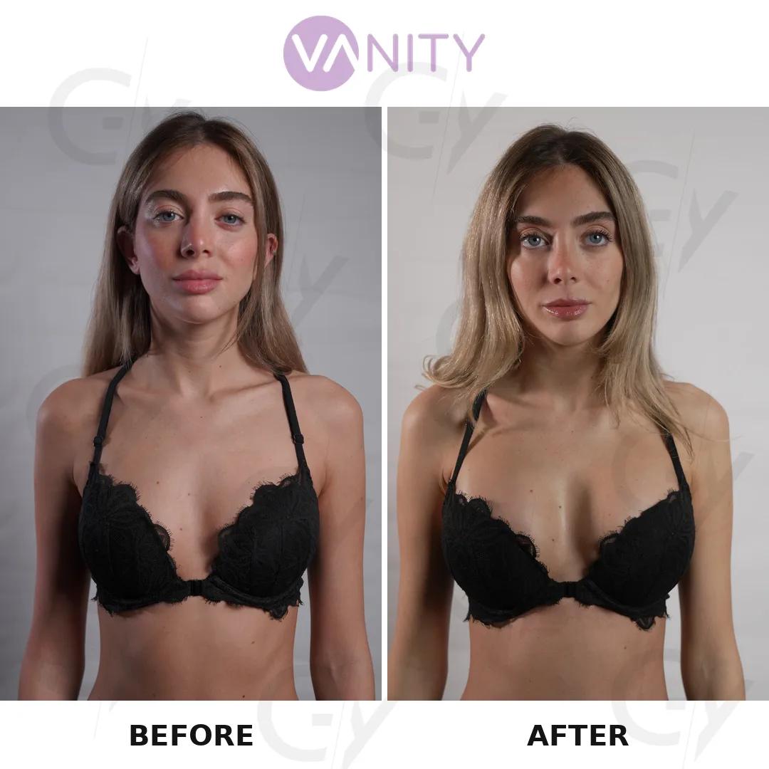 Breast augmentation Istanbul