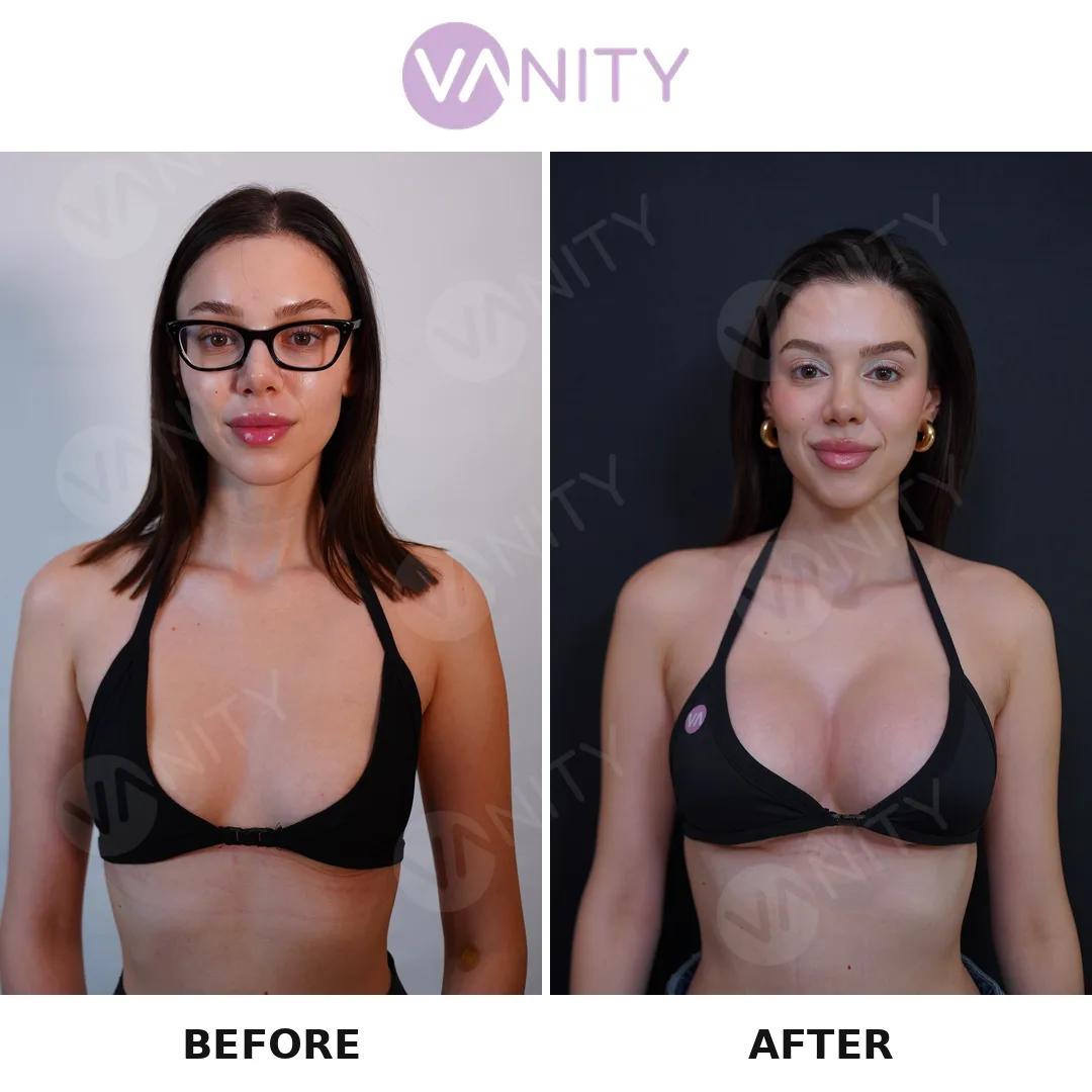 Breast augmentation Istanbul