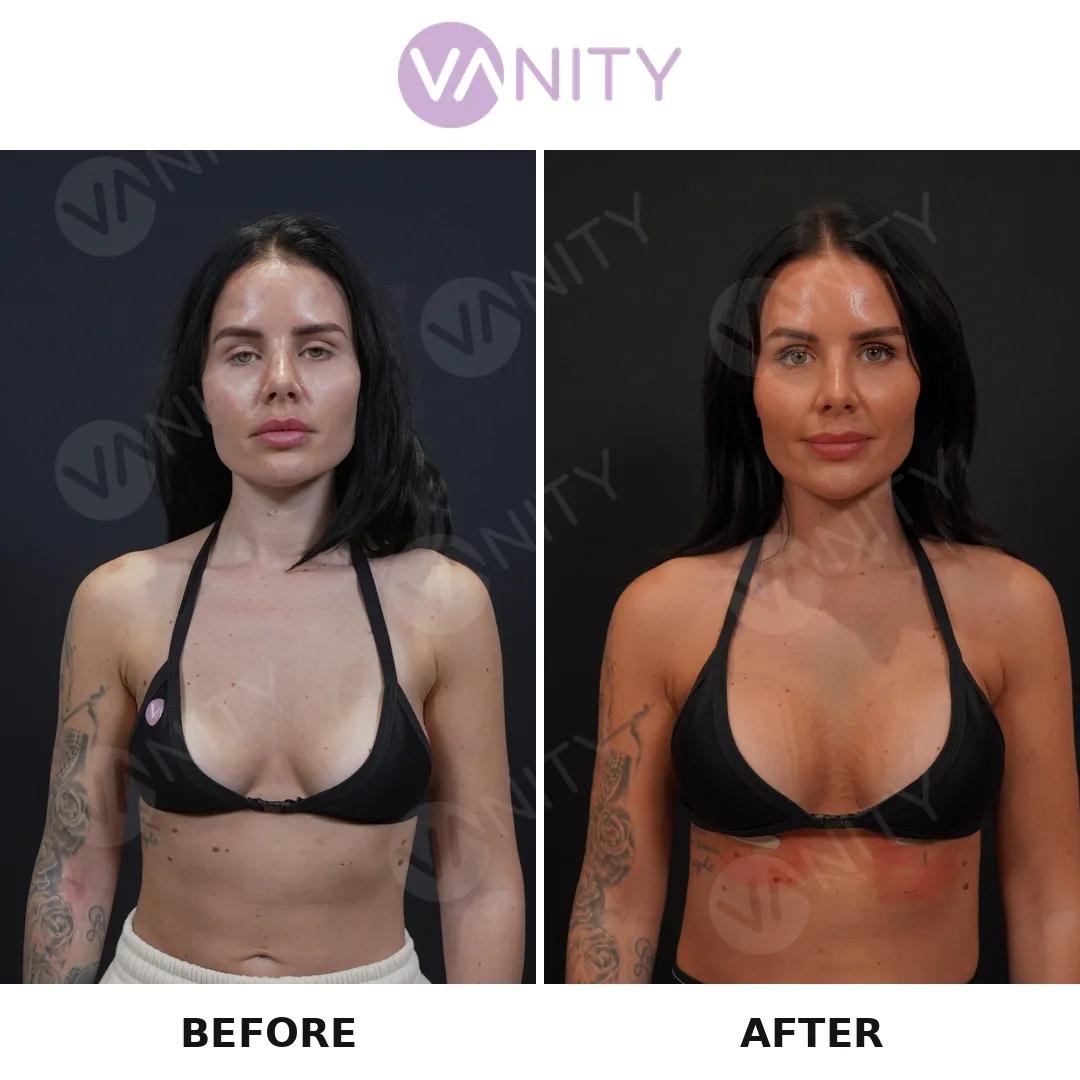 Breast augmentation Istanbul
