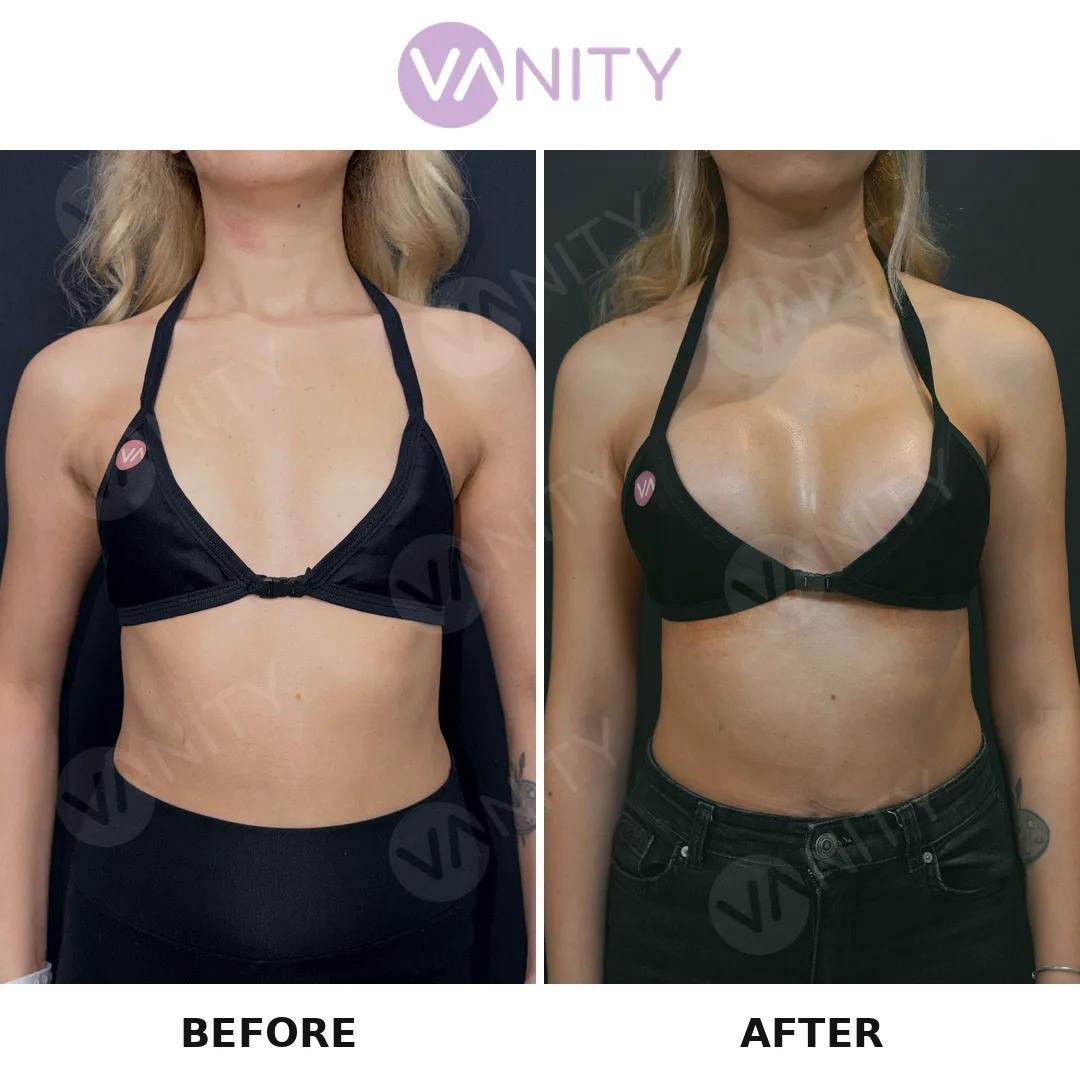 Breast augmentation Istanbul