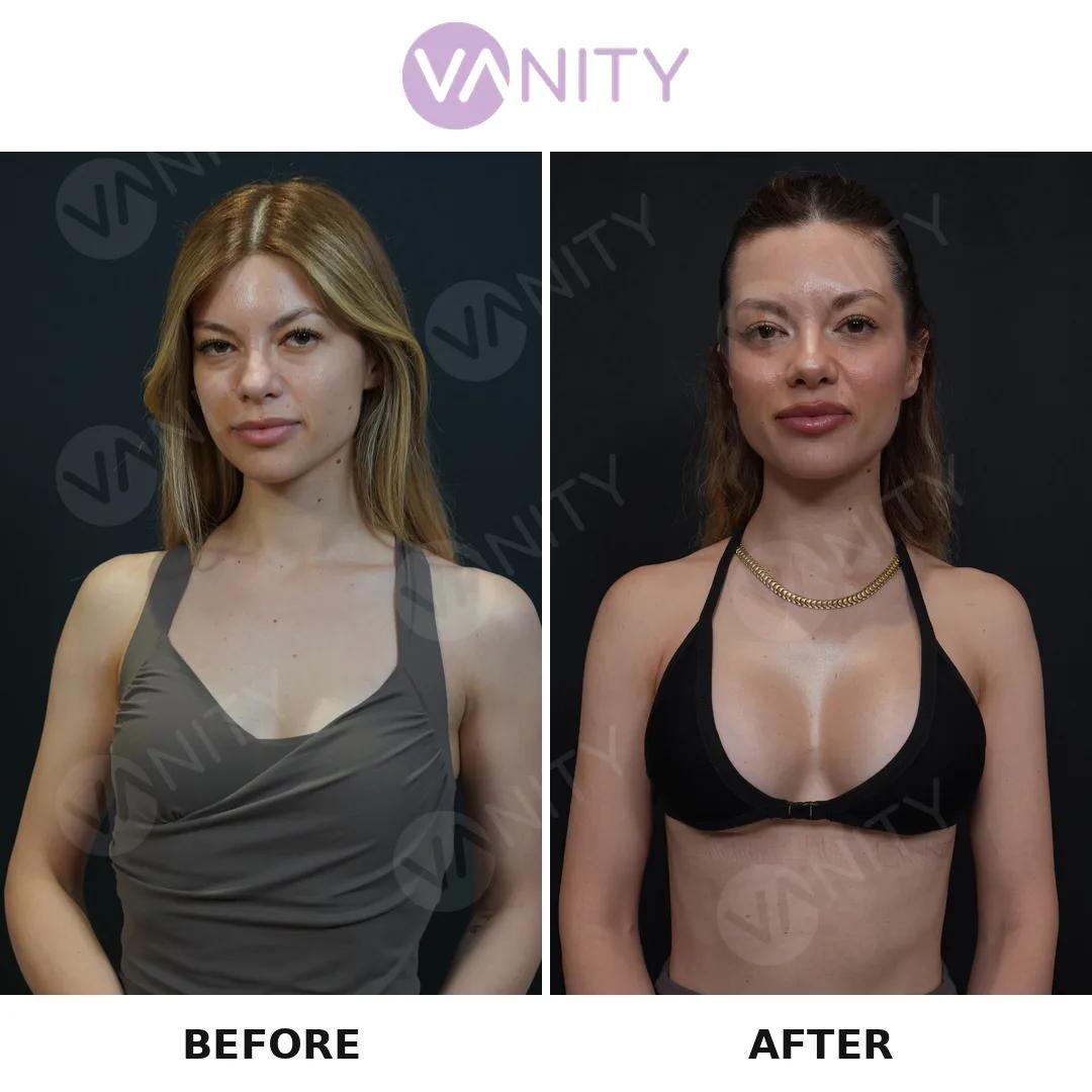 Breast augmentation Istanbul