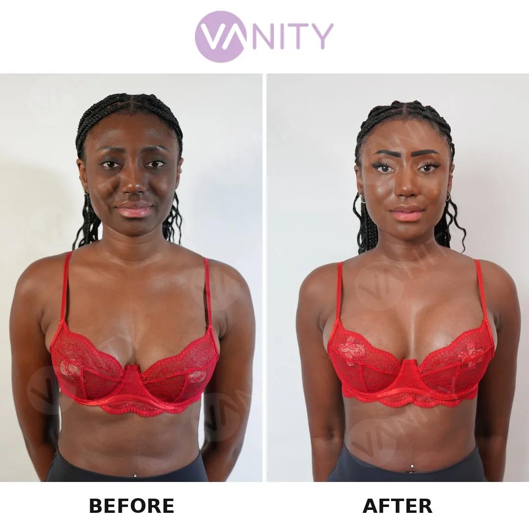 Breast augmentation Istanbul