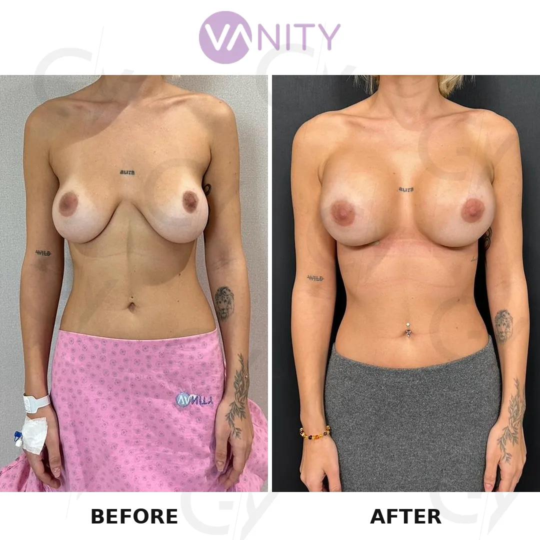 Breast augmentation Istanbul
