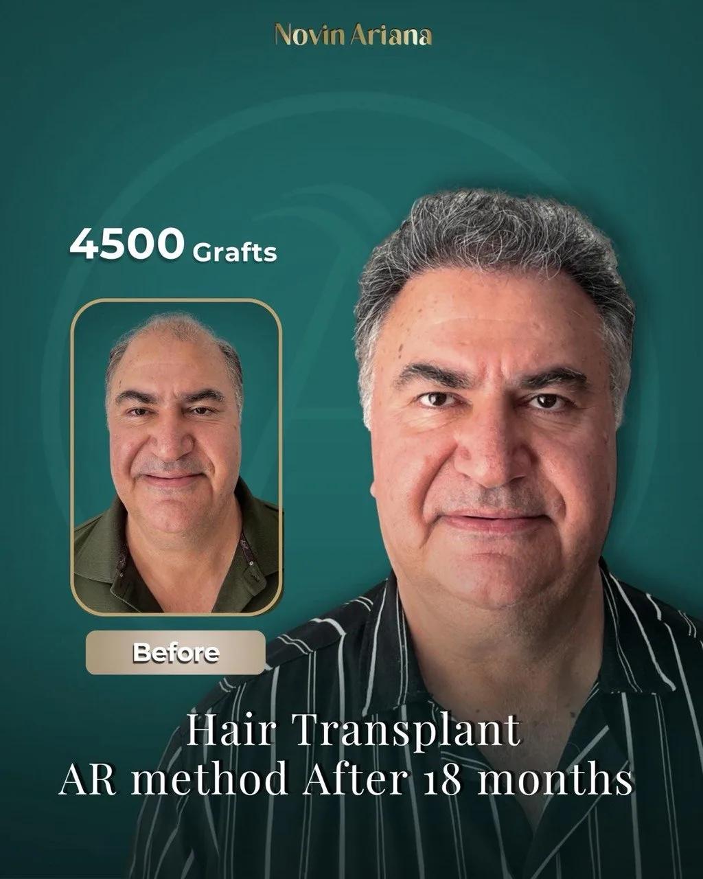 FUE - Novin Ariana BHT Hospital - Istanbul - Turkey 1