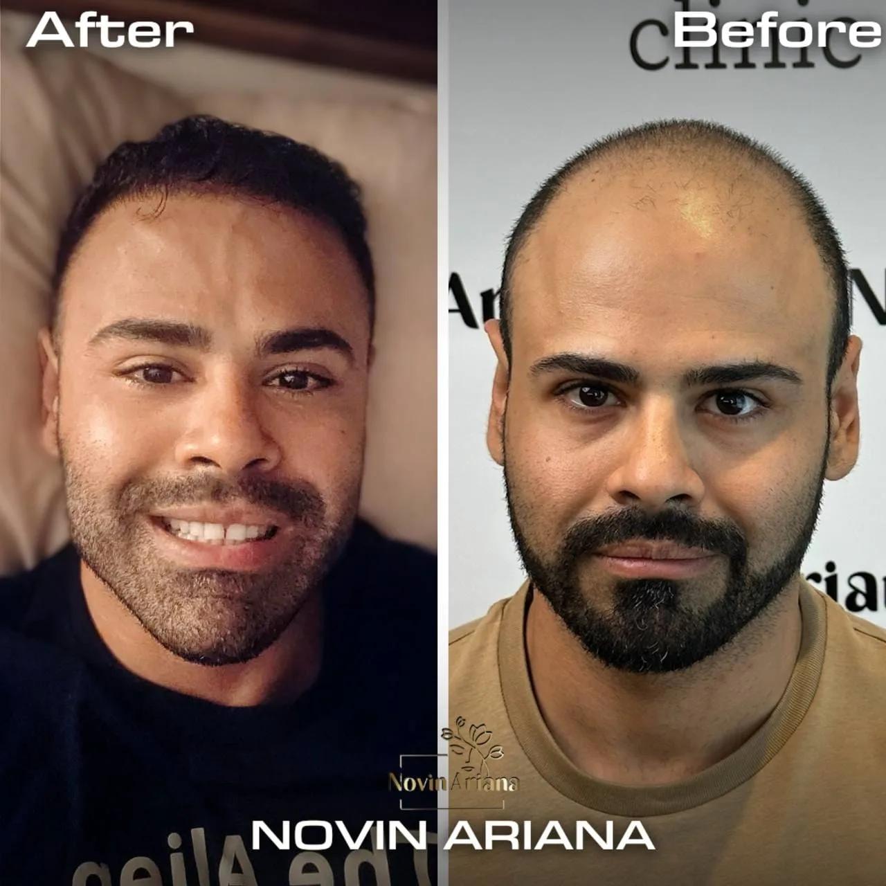 FUE - Novin Ariana BHT Hospital - Istanbul - Turkey 2