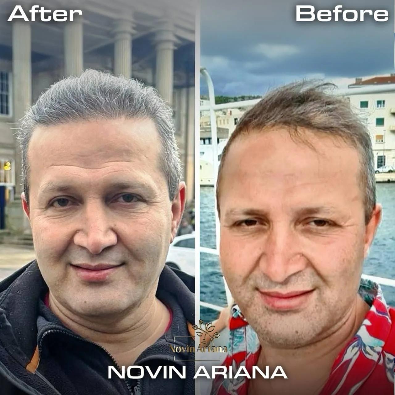 FUE - Novin Ariana BHT Hospital - Istanbul - Turkey 3