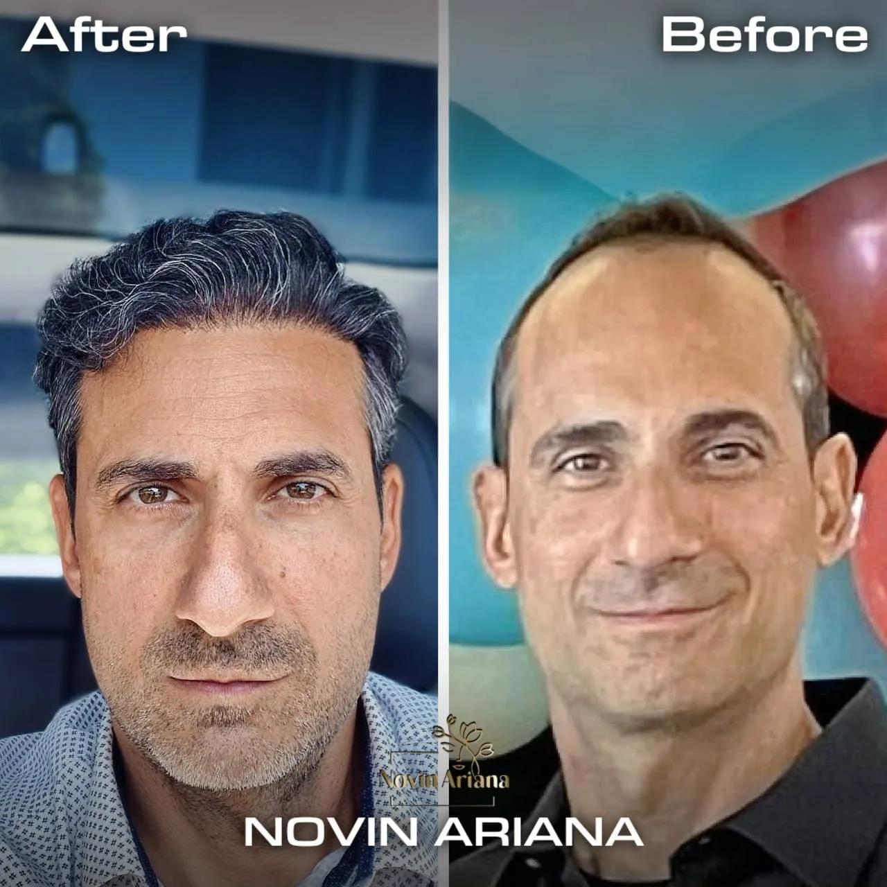 FUE - Novin Ariana BHT Hospital - Istanbul - Turkey