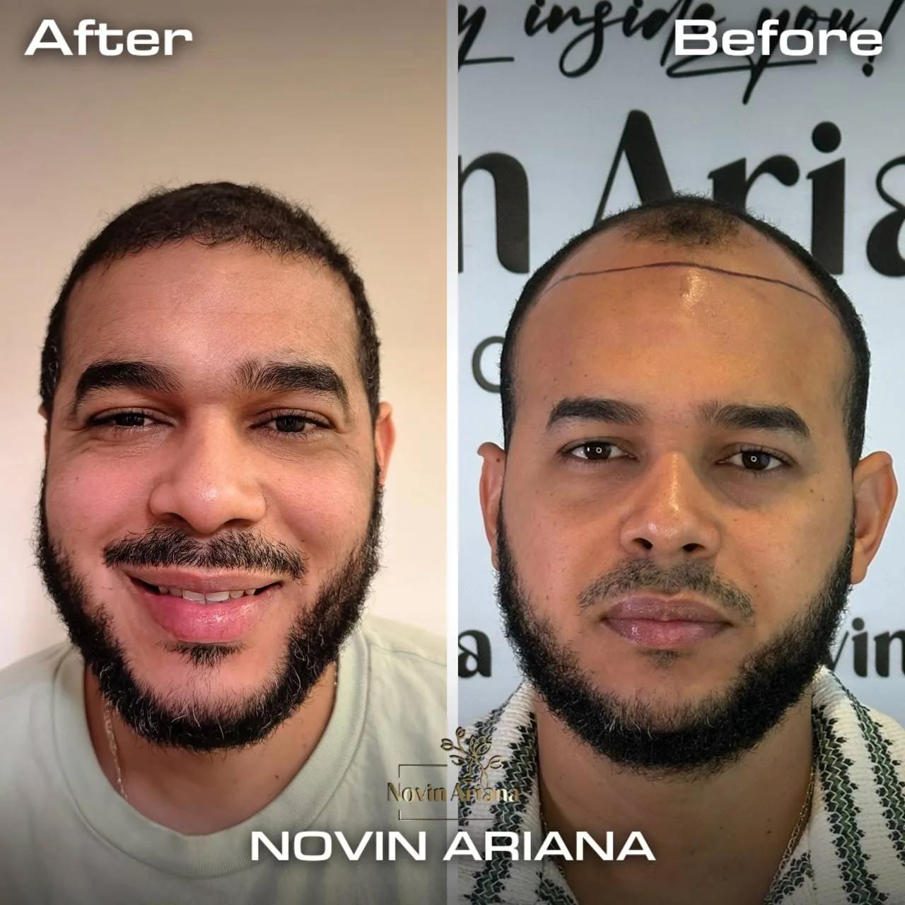 FUE - Novin Ariana BHT Hospital - Istanbul - Turkey 4