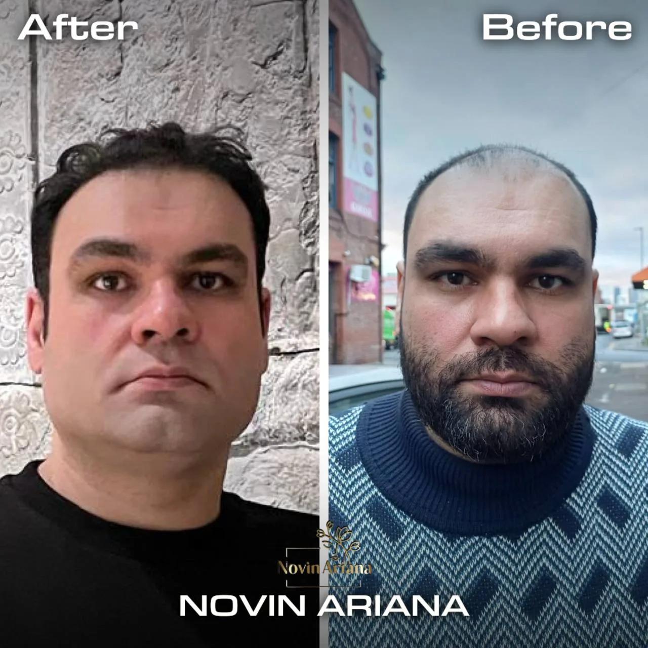FUE - Novin Ariana BHT Hospital - Istanbul - Turkey 5