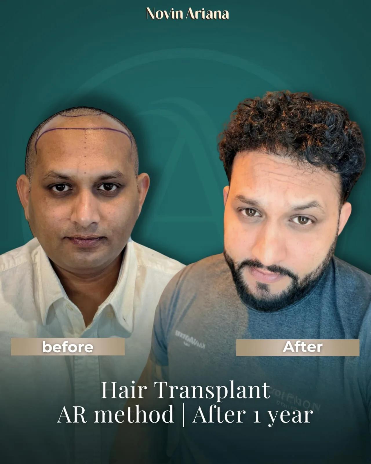 FUE - Novin Ariana BHT Hospital - Istanbul - Turkey 6