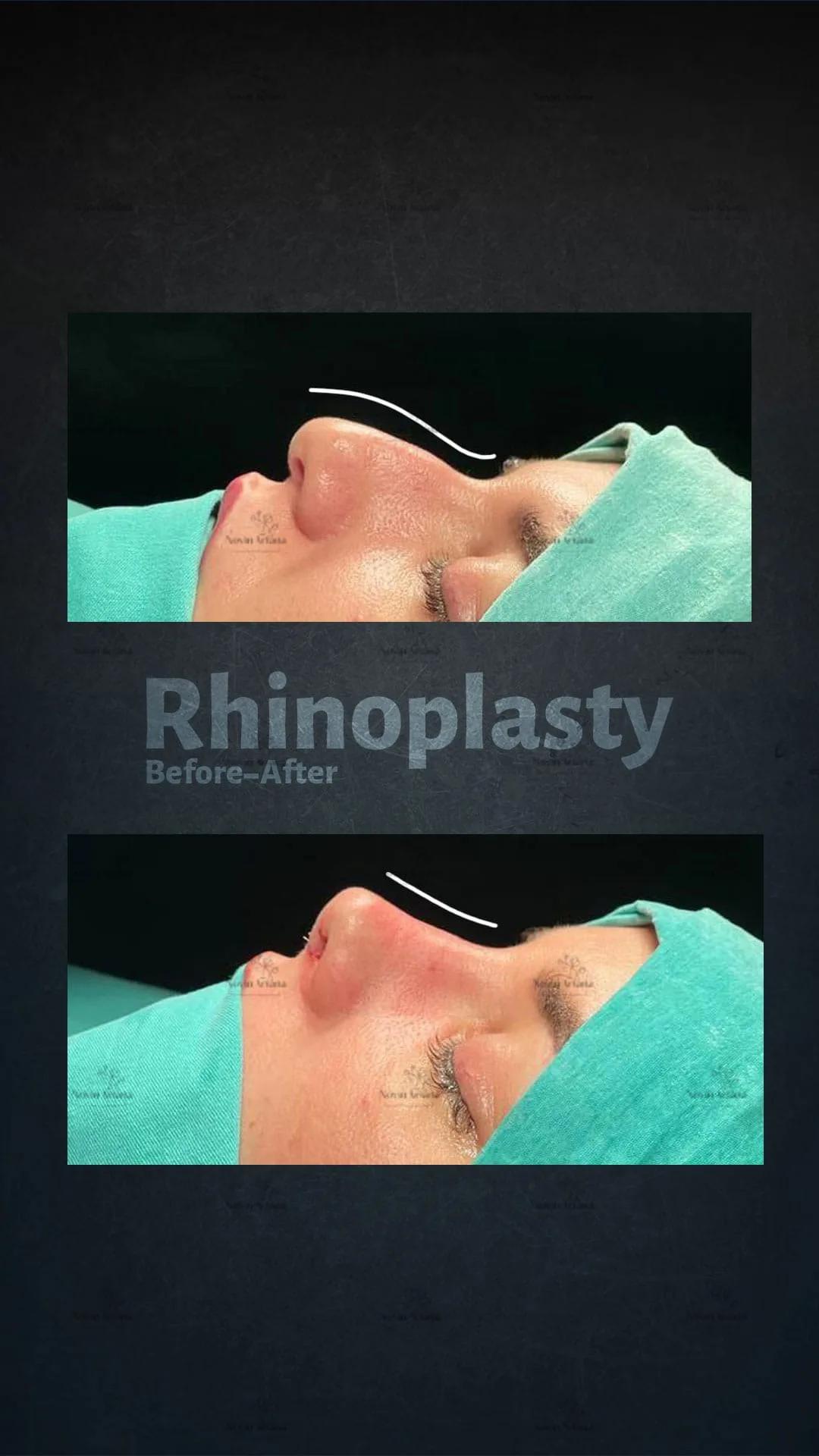 Rhinoplasty - Novin Ariana BHT Hospital - Istanbul - Turkey 1
