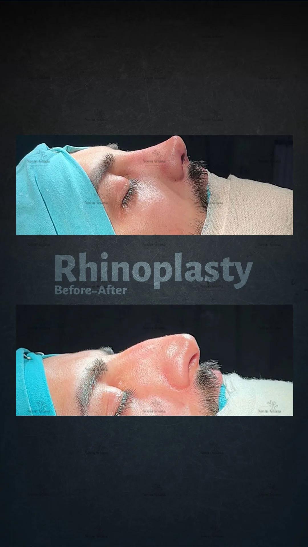 Rhinoplasty - Novin Ariana BHT Hospital - Istanbul - Turkey 2