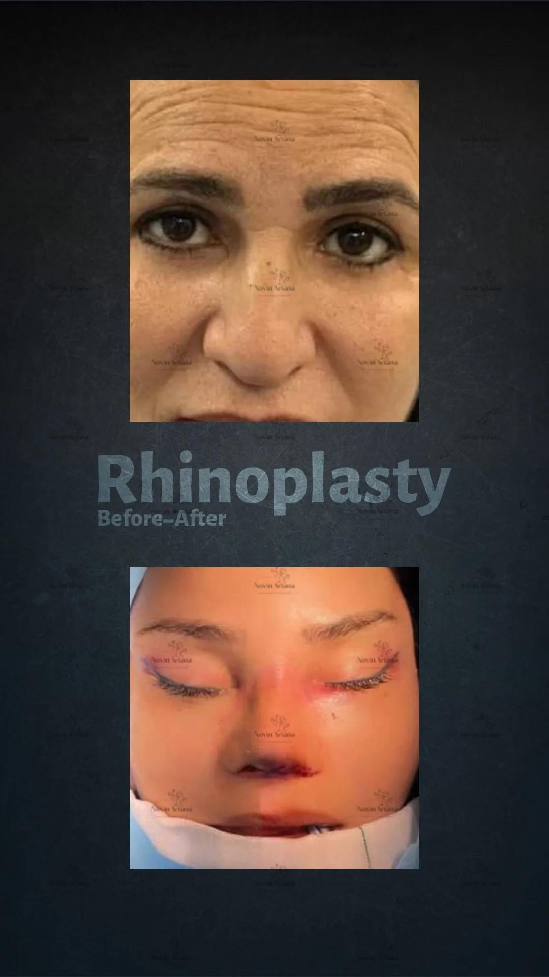 Rhinoplasty - Novin Ariana BHT Hospital - Istanbul - Turkey 3