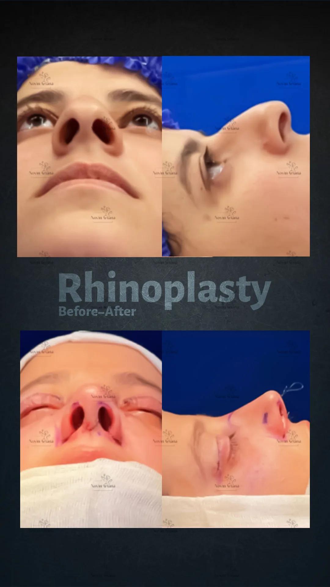 Rhinoplasty - Novin Ariana BHT Hospital - Istanbul - Turkey 5
