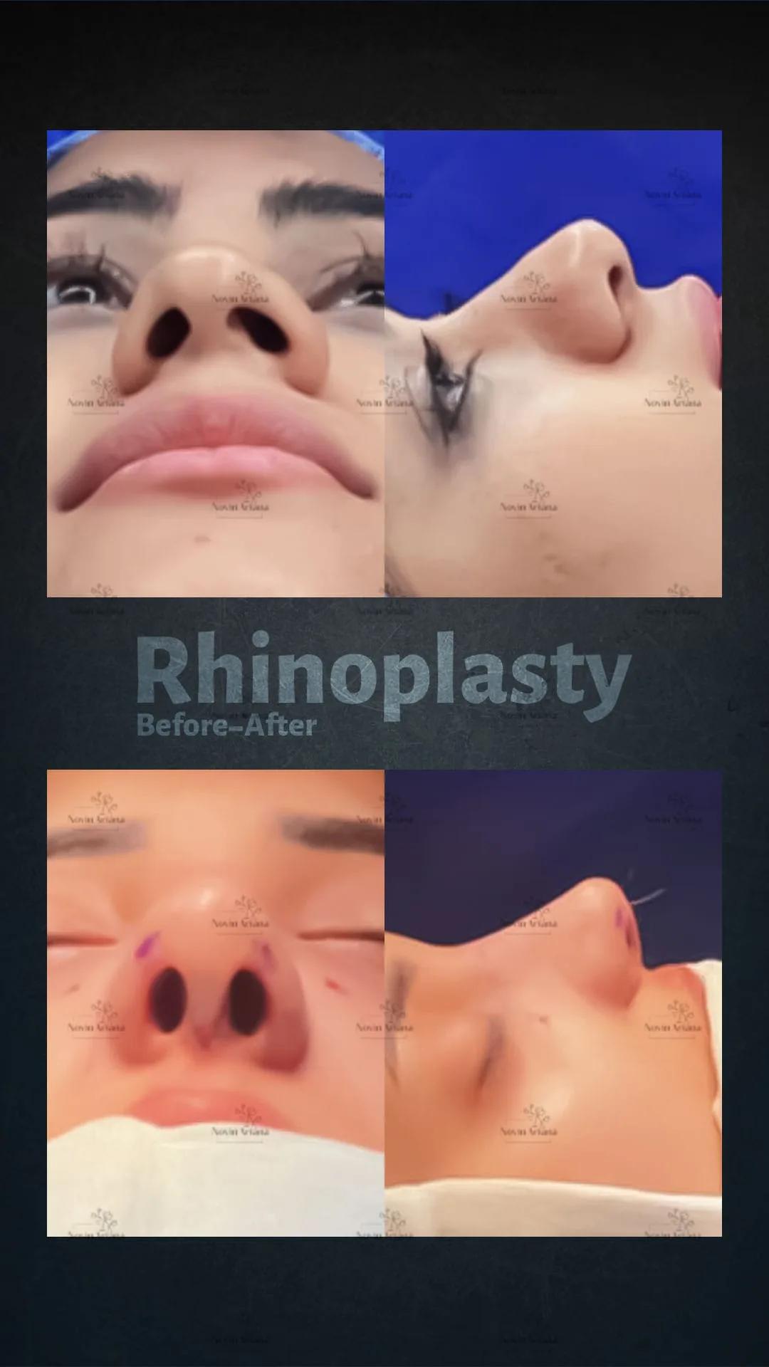 Rhinoplasty - Novin Ariana BHT Hospital - Istanbul - Turkey 6