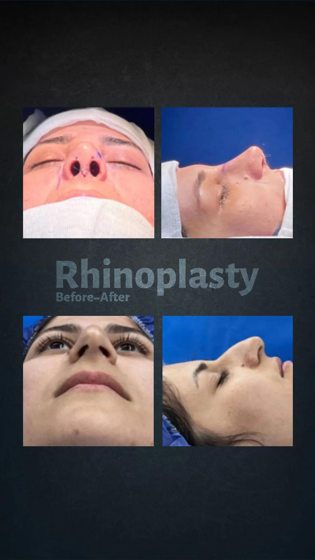 Rhinoplasty - Novin Ariana BHT Hospital - Istanbul - Turkey 7