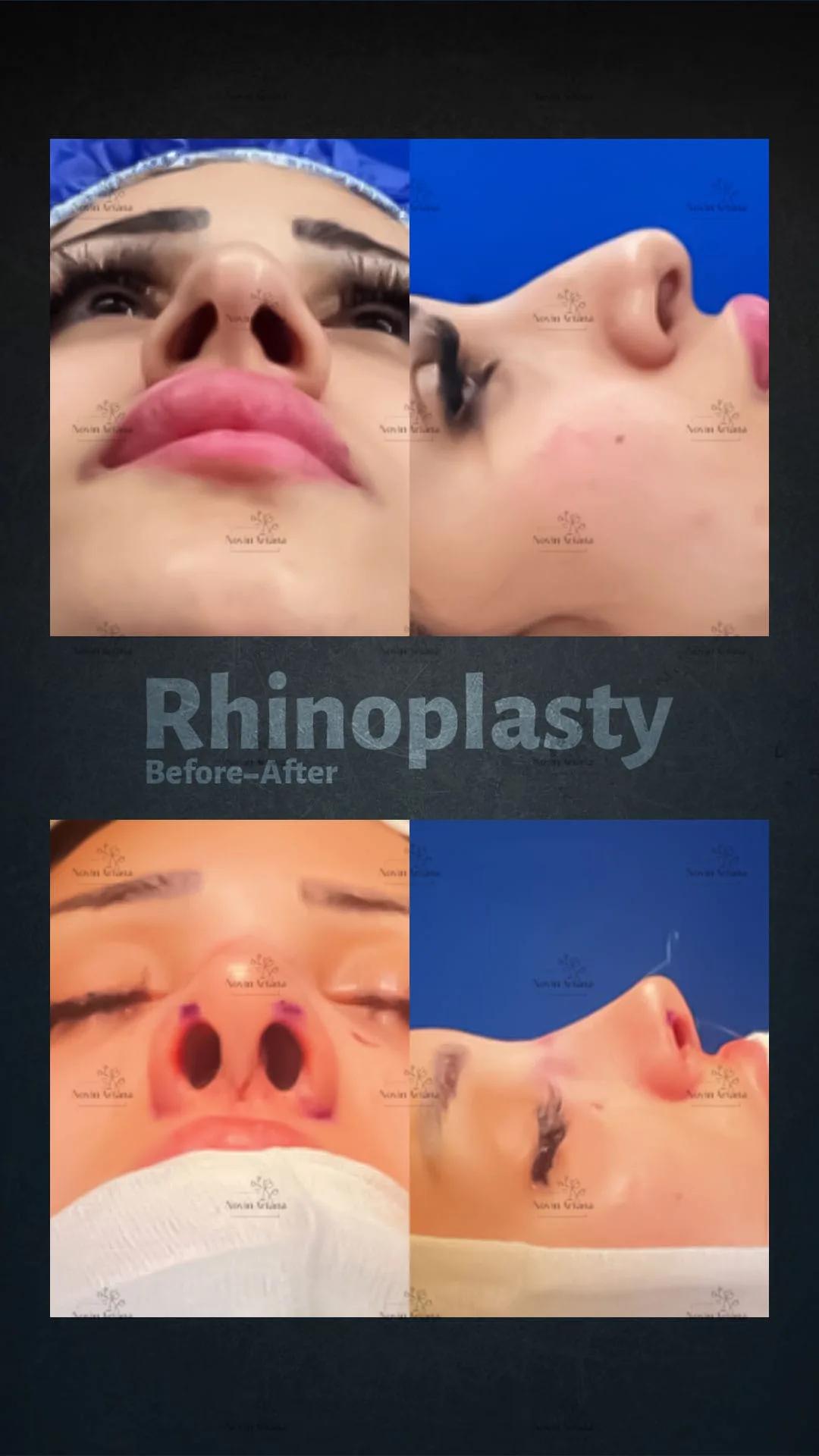 Rhinoplasty - Novin Ariana BHT Hospital - Istanbul - Turkey 8