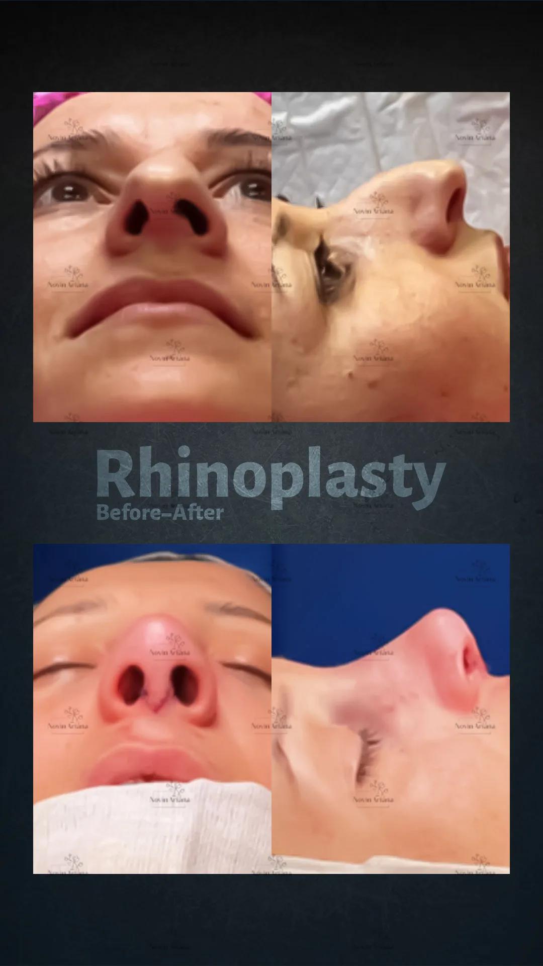 Rhinoplasty - Novin Ariana BHT Hospital - Istanbul - Turkey 9