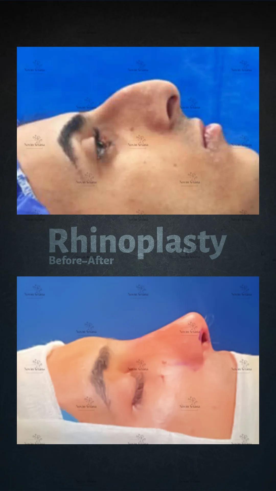 Rhinoplasty - Novin Ariana BHT Hospital - Istanbul - Turkey 10