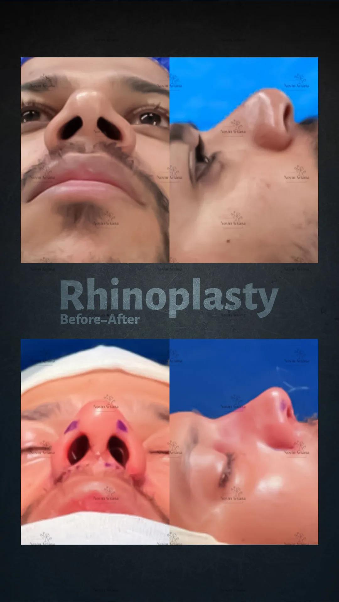 Rhinoplasty - Novin Ariana BHT Hospital - Istanbul - Turkey 11