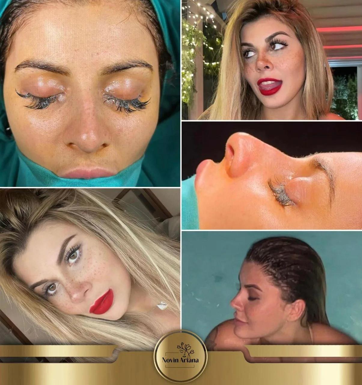 Rhinoplasty - Novin Ariana BHT Hospital - Istanbul - Turkey 12