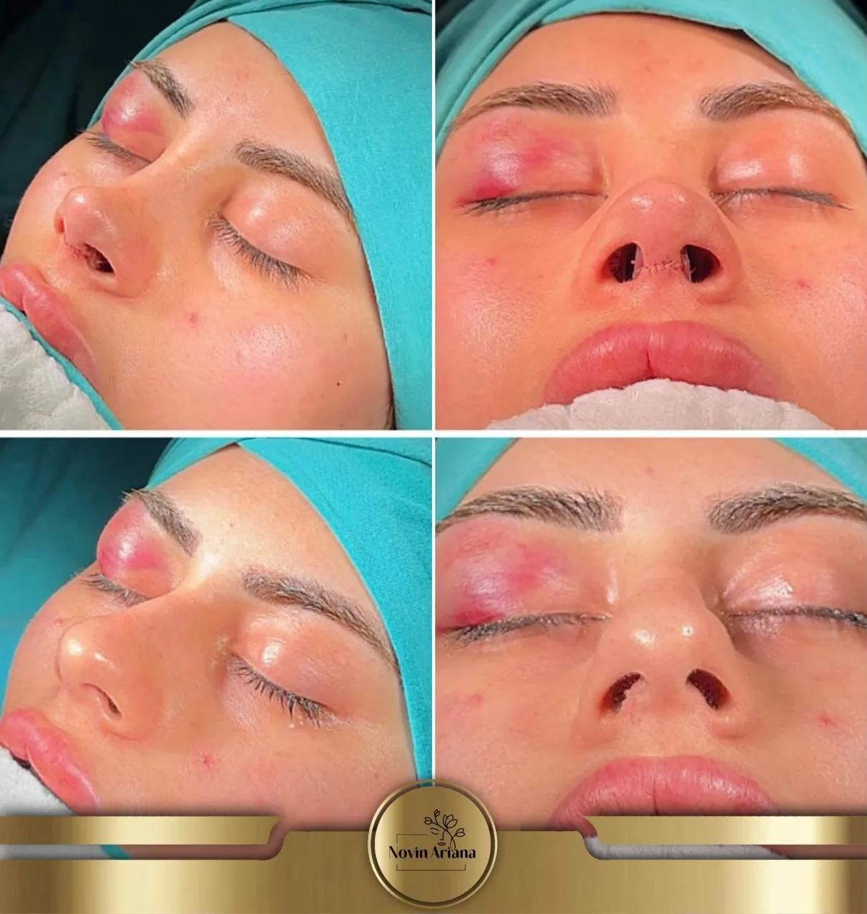 Rhinoplasty - Novin Ariana BHT Hospital - Istanbul - Turkey 14