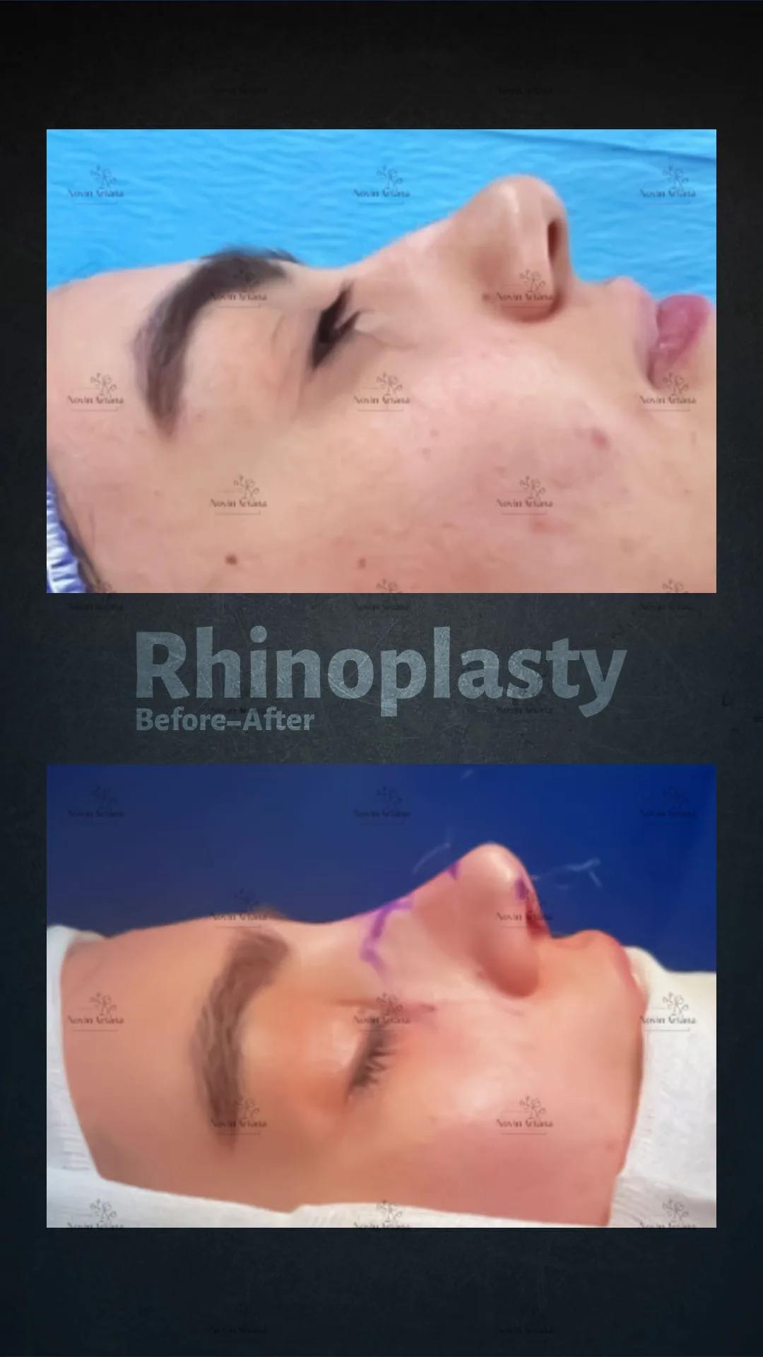 Rhinoplasty - Novin Ariana BHT Hospital - Istanbul - Turkey 15