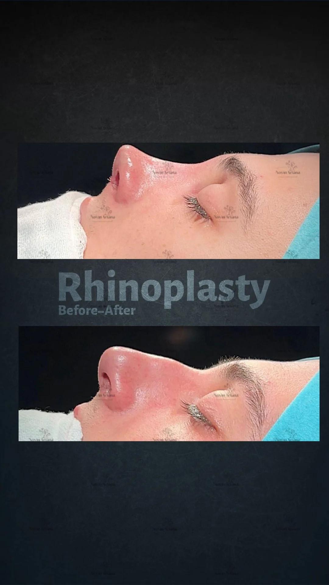 Rhinoplasty - Novin Ariana BHT Hospital - Istanbul - Turkey 19