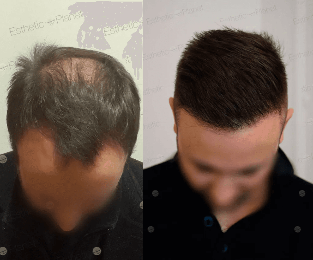 Avant Après 3800 FUE DR BEYHAN TOP VIEW