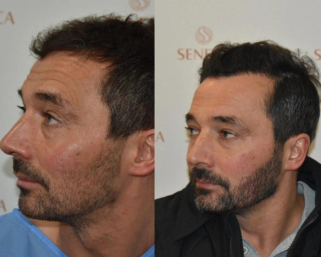 Beard Transplant - Seneca Medical Group - Athens - Greece 1