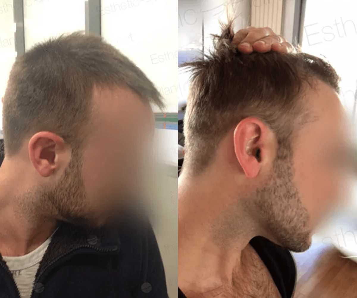 3000 FUE DR BEYHAN side VIEW 2