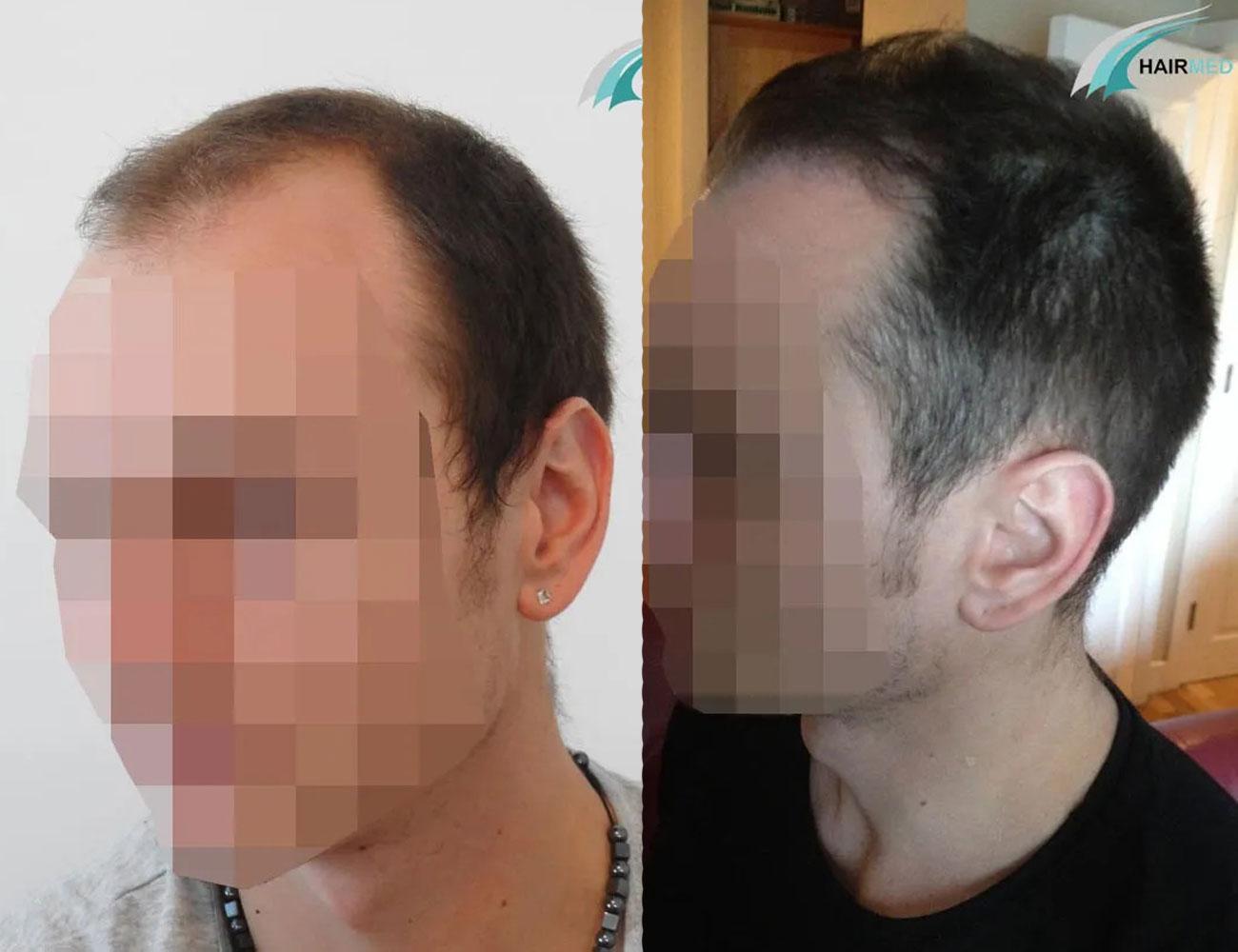 resultat-greffe-cheveux-dr-beyhan