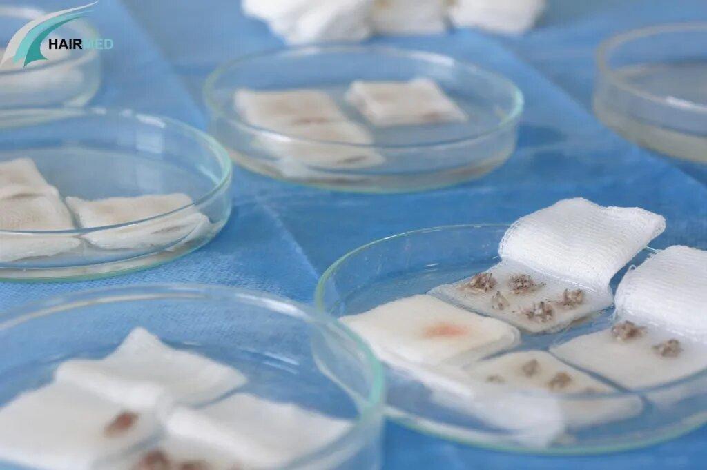 greffon-greffe-de-cheveux-Dr-beyhan-turquie-1024x681