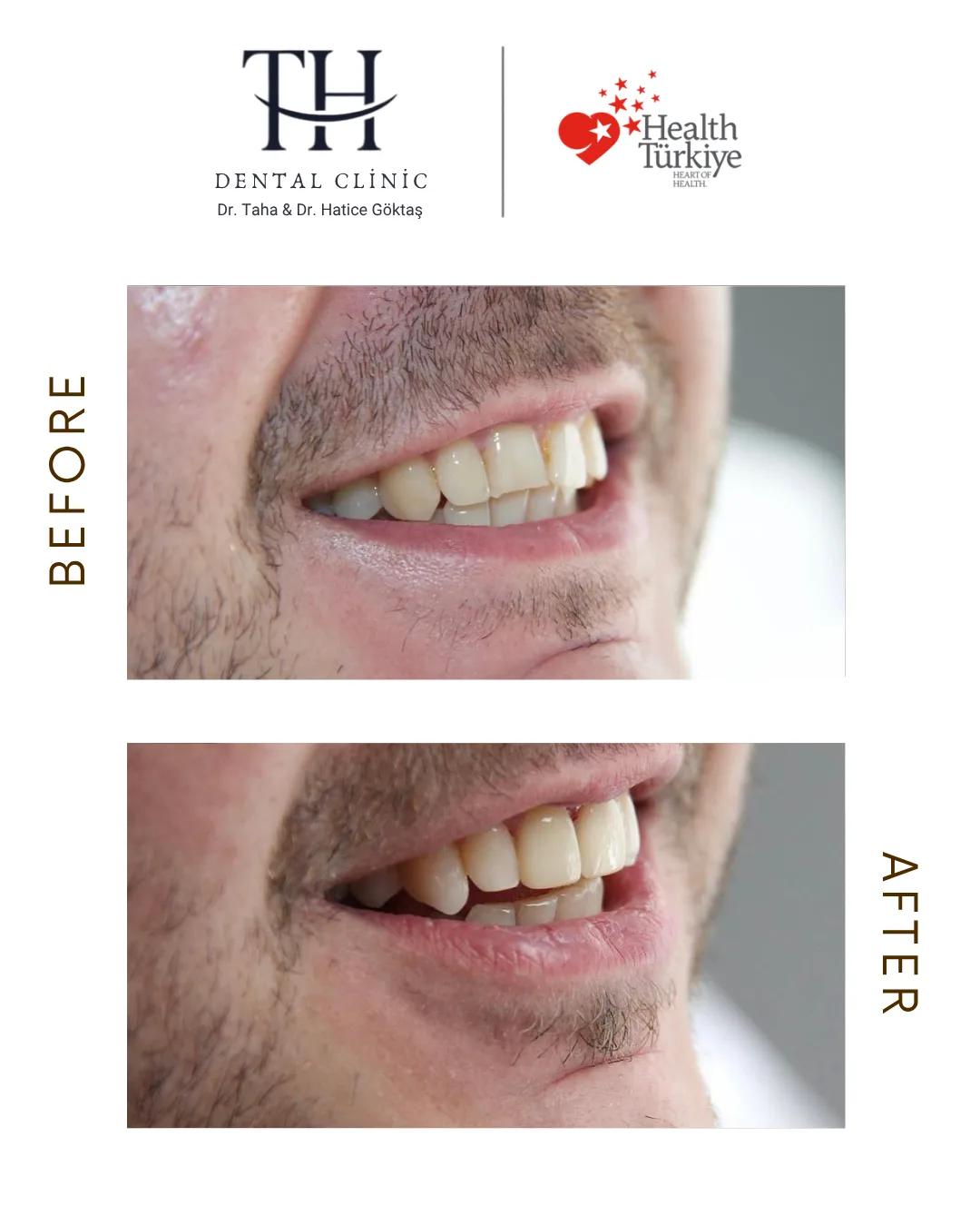 Veneers X 16 - TH Dental Clinic - Istanbul - Turkey 4