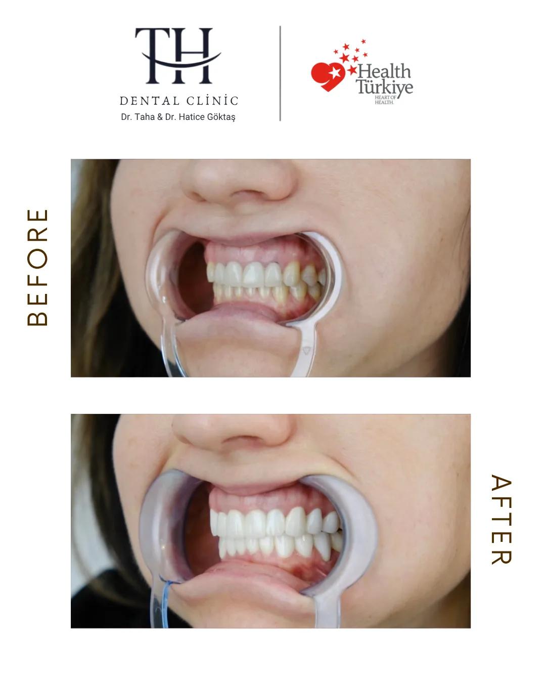 Veneers X 20 - TH Dental Clinic - Istanbul - Turkey 4
