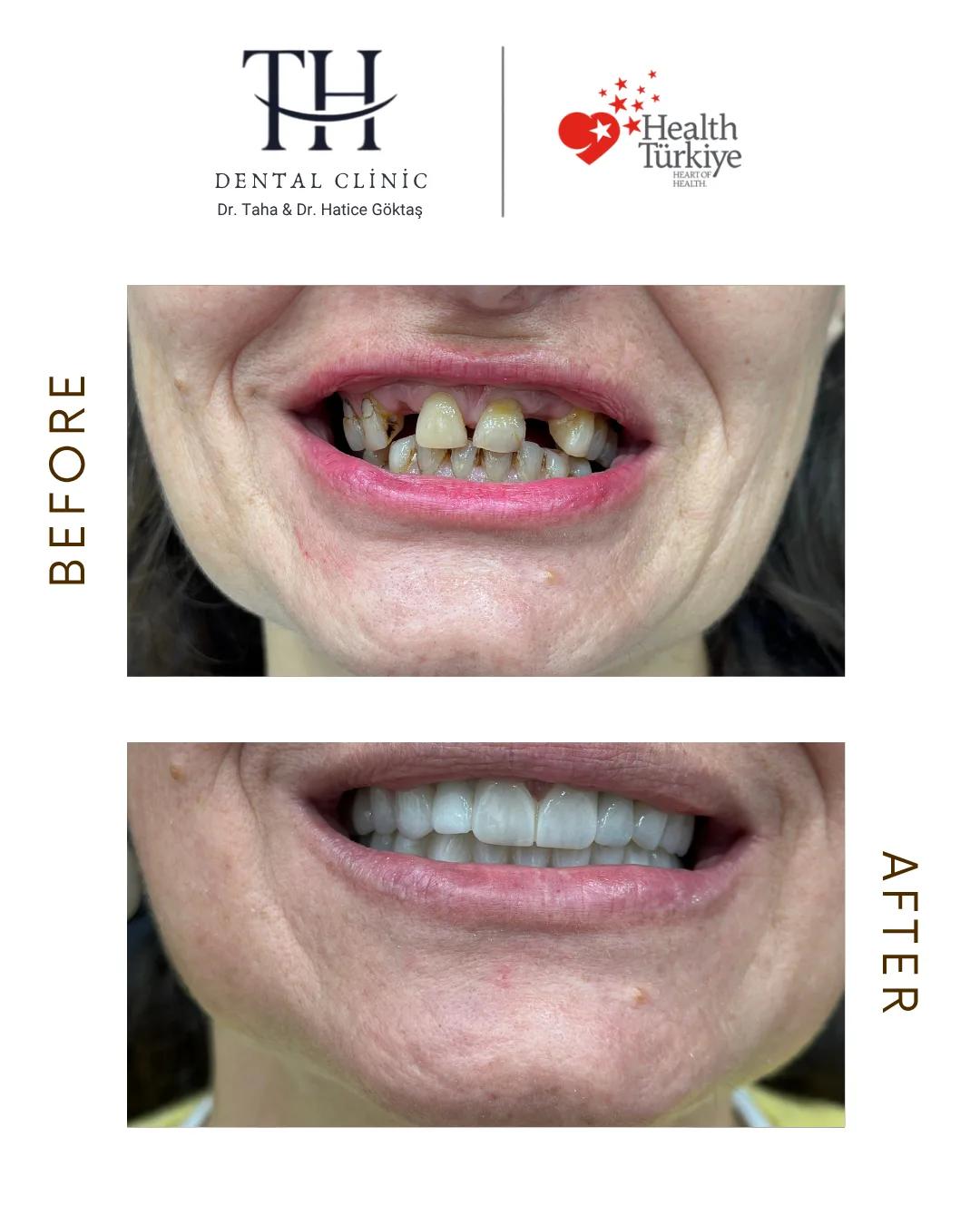 Alpha Bio Dental Implants - TH Dental Clinic - Istanbul - Turkey 2