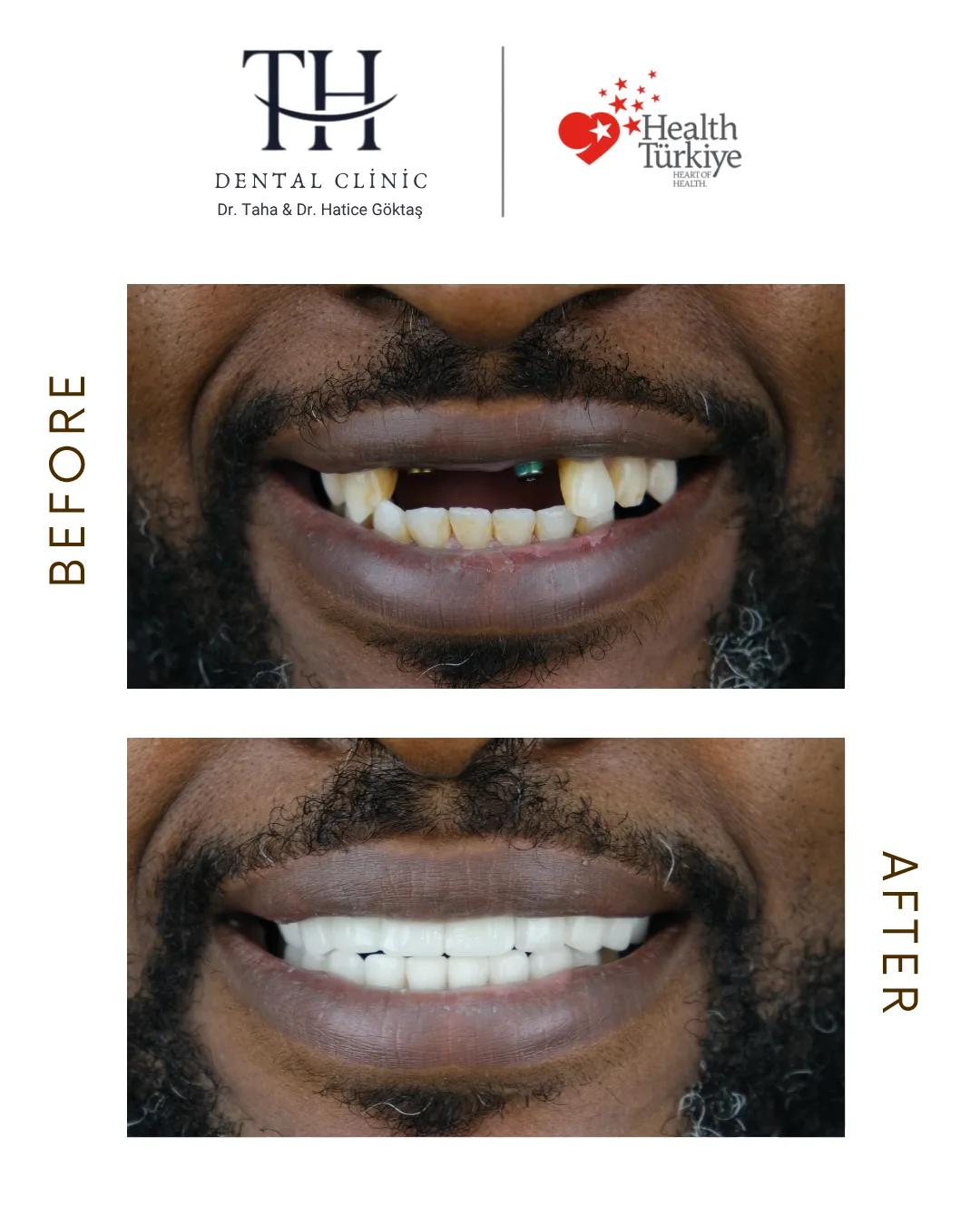 Alpha Bio Dental Implants - TH Dental Clinic - Istanbul - Turkey 3