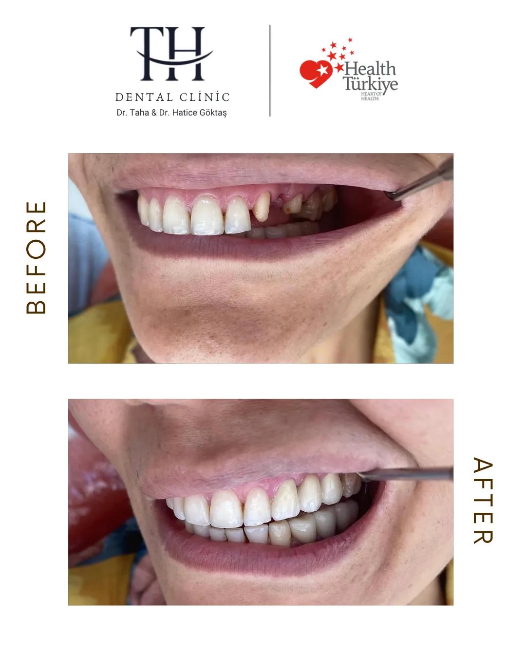 Crowns X 8 - TH Dental Clinic - Istanbul - Turkey 1